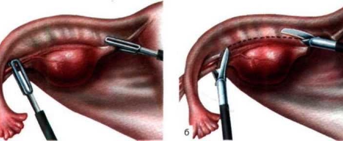 Киста, значительных размеров